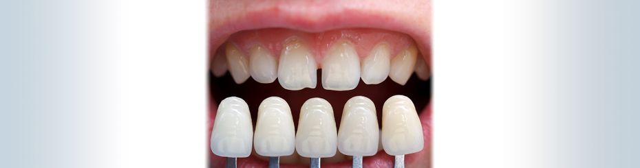 All About Veneers: How to Care for Your Veneers from Your Cosmetic Dentist in North Edmonton