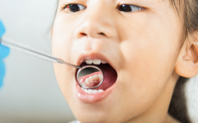 How to Spot and Prevent Cavities in Kids’ Teeth